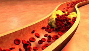Mỡ máu cao là gì và các tại hại của mỡ máu cao bạn cần biết